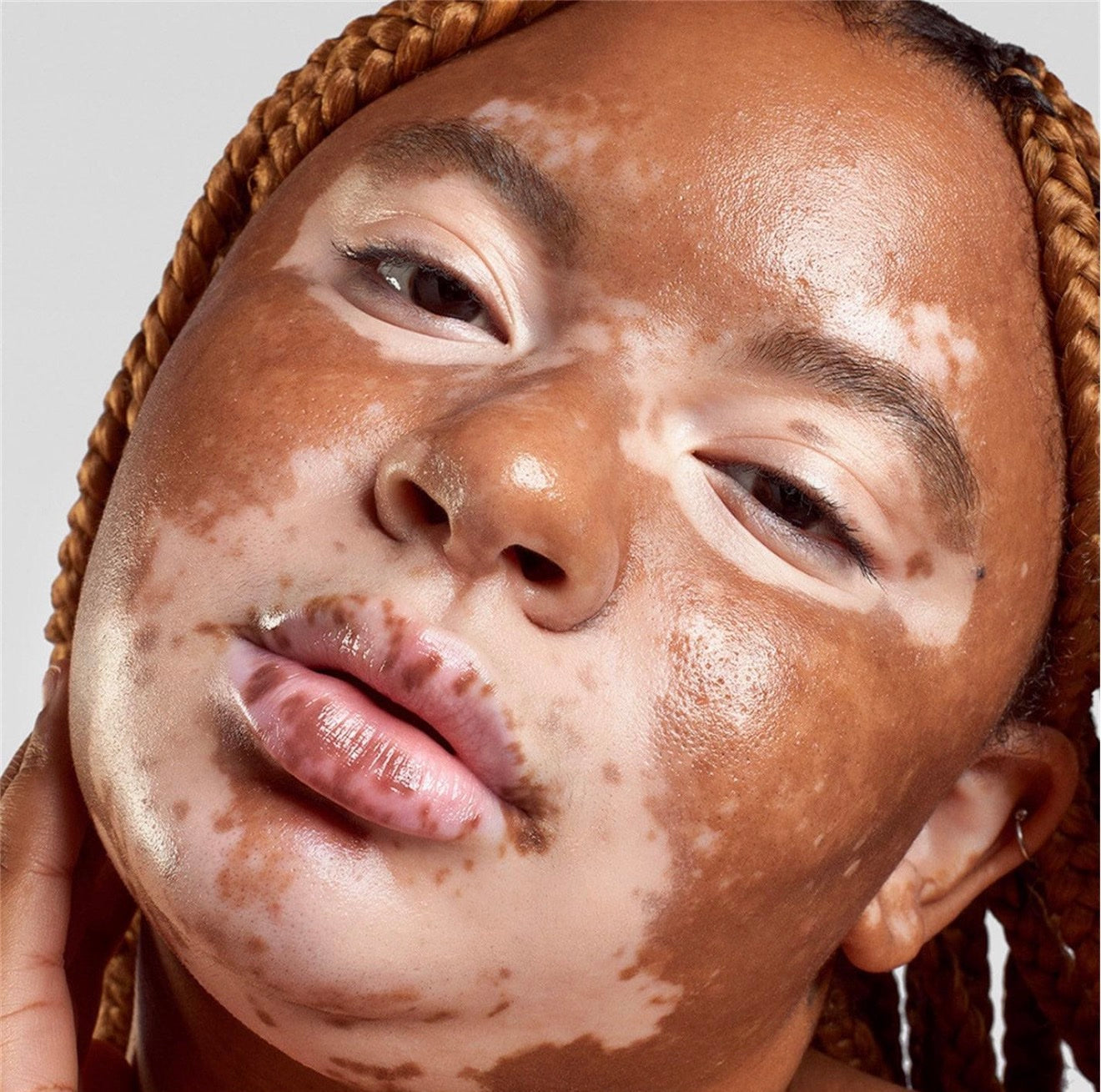 Portrait of a woman with braids and vitiligo, glowing skin